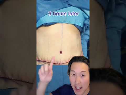 Person showing loose skin transformation after massive weight loss journey